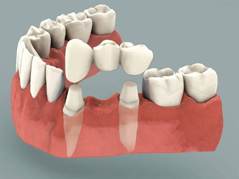 Prosthetic Treatment