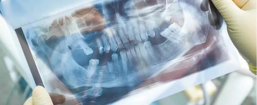 Dental X-Ray